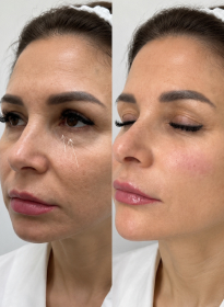 Контурная пластика лица